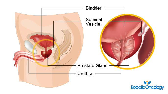 About Prostate Cancer